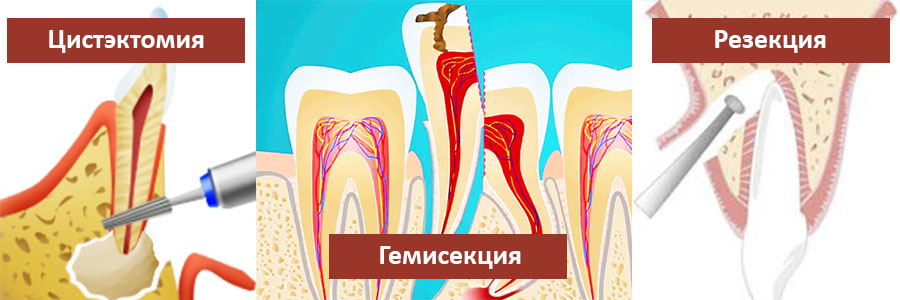 Схема резекции верхушки корня